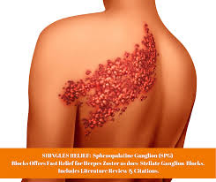 Herpes zoster ophthalmicus (hzo), also known as ophthalmic zoster, is shingles involving the eye. Shingles Relief Spg Blocks Offers Fast Relief For Herpes Zoster