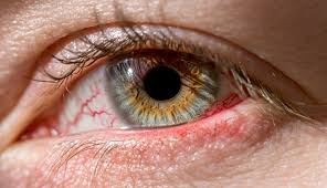 Image result for Eye Pain without Redness