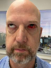 Fog-free goggles for winter riding conditions?