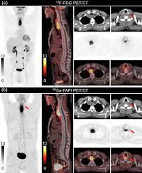 The applicable tracer code should be billed when billing for a pet scan service. Pet Ct Scan Cpt Code