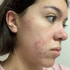 You look great in those Curology polka dots, @laurenxelisa! What Lauren is  demonstrating here is the best way to make sure you get the most out of  your formula what we call