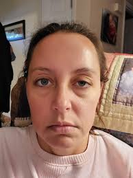 Rescuing an opossum with a traumatic brain injury