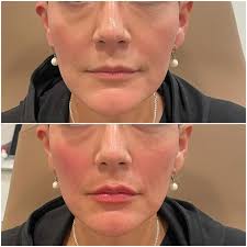 Ashley Ferguson Head MSN, FNP-C (@ashley.fineline.aesthetics) • Instagram  photos and videos