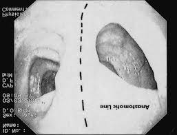 Mild to moderate diarrhea may occasionally persist for weeks to months after surgery, and some cats may have recurrent constipation. A Nickel Titanium Memory Shape Device For Colonic Anastomosis In Laparoscopic Surgery Springerlink