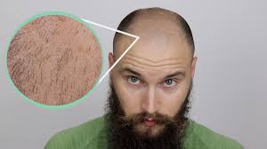 Whether you use one or. Balding Hair Growth Growing Out My Balding Hair Youtube