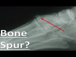 If treatment is needed, it depends on where spurs are located most bone spurs cause no signs or symptoms. Bone Spur On Top Of The Foot Treatment For Bumps Lumps Youtube