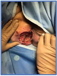 Early symptoms will begin within 24 hours of being infected and often start with a general feeling of being unwell. Fournier S Gangrene With Dapagliflozin In A Rural Hospital A Case Report Bmj Case Reports