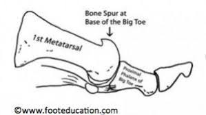 Hallux Rigidus Aka Hallux Limitus Footeducation Big Toe Hallux Bone Spurs