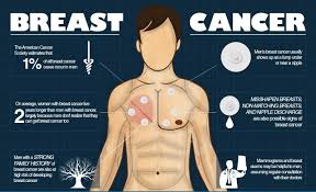 اعراض سرطان الثدي للرجال