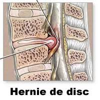 Hernia de disc apare adesea pe masura inaintarii in varsta, cand discurile intervertebrale isi pierd o fa exercitii. Hernie De Disc Medicina24