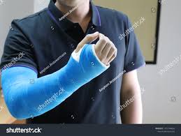 Image result for Long Arm Cast