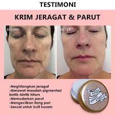 Ada banyak langkah untuk mengatasi jerawat batu dengan ampuh, keliru satunya daftar 10 merk obat menghilangkan jerawat parah dengan ampuh bpom. Krim Jeragat Dan Parut No 1 Indonesia Shopee Malaysia