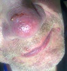 Wenn akne ein wiederkehrendes problem in ihrem leben ist, ist es zeit, dass sie sich mit den verschiedenen arten von akne vertraut machen, um das problem von den wurzeln aus zu behandeln und eine klare haut zu erreichen. Rosacea Wikipedia