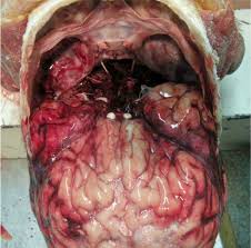Small shot that is useful for downing birds and squirrels. Pathology Outlines Gunshot Wounds