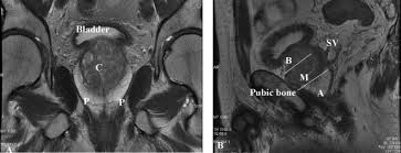 A Coronal T2wi And B Sagittal T2wi Showing Cranio Caudal Download Scientific Diagram