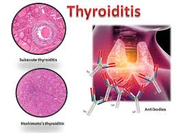 Image result for Thyroiditis