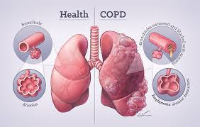 Chronic obstructive airways disease (coad) comprises the syndromes of asthma, chronic bronchitis, and emphysema. Chronic Obstructive Pulmonary Disease Copd Mrinz