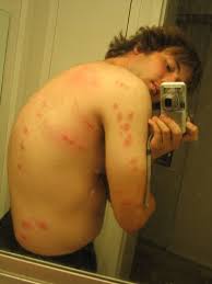 Antenna that have four parts; The Agony Of Having Bed Bugs In Kuala Lumpur Malaysia Pinoy Boy Journals
