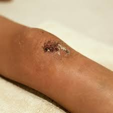 In certain types of wounds, developing an infection is more likely. How To Tell A Wound Is Infected Urgentmed Network