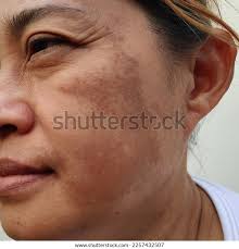 224+ Thousand Freckles Royalty-Free Images, Stock Photos & Pictures