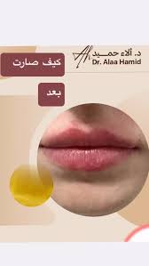 تعديل بسيط و يضيف جمالا الي الجمال الاصلي , شفة غير متناسقة رقة في الشفة  العليا مقارنه بالسفلى خاصه الجوانب , #تجميل #dermatologist #فلير #شفايف ,  الشكل الطبيعي الجمال الطبيعي