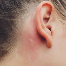 Image result for dermatitis contacta allergica