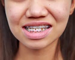 Meu Filho Tem Dentes Tortos O Que Fazer Uniodonto Minas