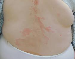 Systemic Contact Dermatitis Contact Dermatitis Systemic Baboon Syndrome Fisher S Systemic Contact Dermatitis Systemic Contact Type Dermatitis Hematogenous Contact Eczema Symmetrical Drug Related Intertriginous And Flexural Exanthem Sdrife