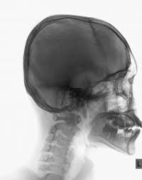 Image result for Skull XRay