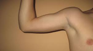 Ketiak adalah salah satu bagian tubuh yang jarang diperhatikan, namun memiliki banyak masalah penyebab benjolan di ketiak yaitu infeksi bakteri atau virus, limfoma, hingga pertumbuhan sel kanker. Benjolan Di Ketiak Punca Dan Rawatan The Diagnosa