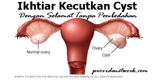 Ada 3 punca cyst dalam ovari wanita. Punca Cyst Ovari Archives Provide Network