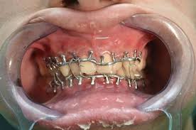 13 Diets You Ve Never Heard Of From Least To Most Insane Diet Mouth Wire