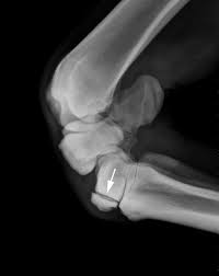 Capitate and all other carpal bones lie posterior to lunate on lateral radiograph. Fracture Of The Carpal Bones In Horses Musculoskeletal System Veterinary Manual