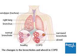 The main symptoms include shortness of breath and cough with mucus production. Chronic Obstructive Pulmonary Disease Copd Bupa Uk
