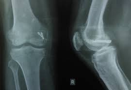 Maybe you would like to learn more about one of these? Cureus A Case Of Distal Femur Medial Condyle Hoffa Type Ii C Fracture Treated With Headless Screws