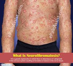 What is neurofibromatosis type 1 (nf1)? Neurofibromatosis Treatment Symptoms Causes