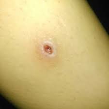 Wunde Doccheck Flexikon