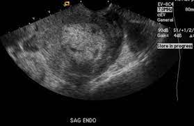 Retained Products Of Conception Radiology Reference Article Radiopaedia Org
