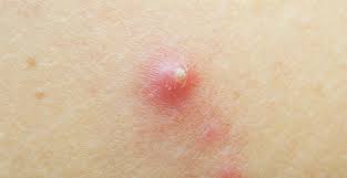 Kondisi ini memang sedikit mengganggu. 10 Penyebab Bisul Makanan Tak Sehat Hingga Imun Lemah