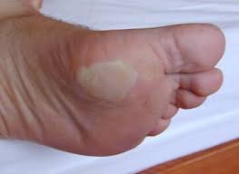 Image result for blister