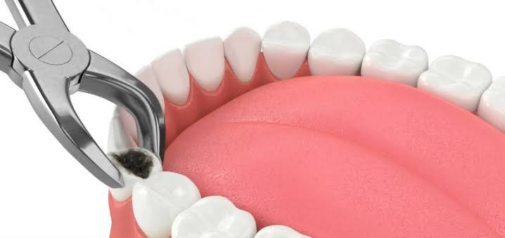 Tooth Extractions product image