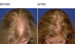 Prp injections are an emerging modality for promoting new hair growth and increasing hair thickness in male and female patients with hair loss. Pin On Prp For Hair Loss Treatments