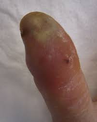 Image result for Hand Infection