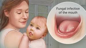 Baking soda with oatmeal milk bath. Thrush And Breastfeeding