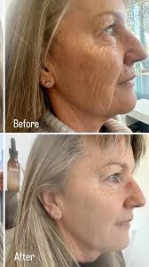 IPL PIGMENT REMOVAL ✨ , This result was achieved after one session. , Both  my client and I are thrilled with the results. , If pigmentation, freckles,  dark spots, redness, veins or lines and ...