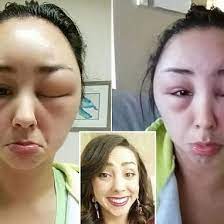 Woman Documents Scary Allergic Reaction To Hair Dye In Dramatic Images Hair Dye Allergy Dyed Hair Face Allergic Reaction