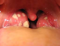 Eine aussackung im unteren rachen heißt divertikel; Erkrankungen Der Mundhohle Und Des Rachens Oropharynx