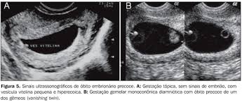 Radiologia Brasileira Anormalidades Do Primeiro Trimestre Da Gravidez Ensaio Iconografico