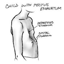 Maybe you would like to learn more about one of these? What Is Pectus Excavatum Growing Up With Pe Causes Surgery And Exercise Hubpages