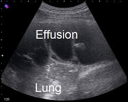 In healthy lungs, these membranes ensure that a small amount of. Pleural Space Infections Empyema Pulmonology Advisor